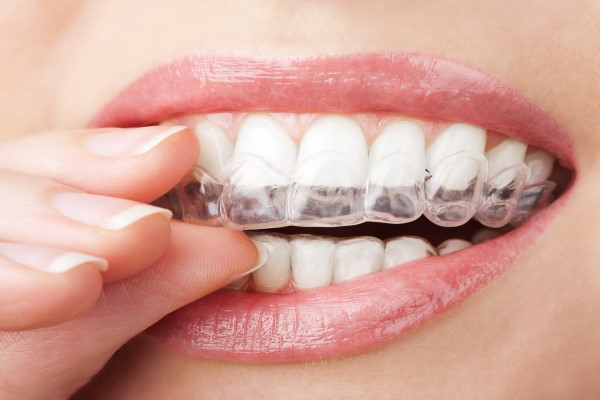 Clear Braces: What Are They?