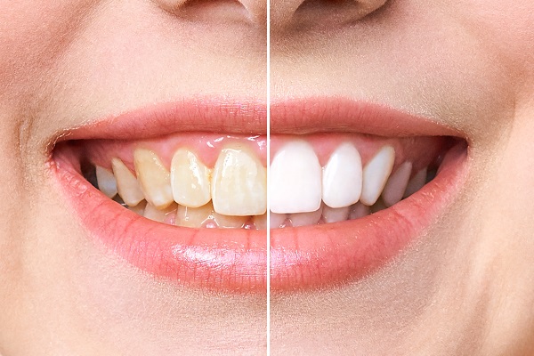 Does Professional Teeth Whitening Produce Permanent Results?
